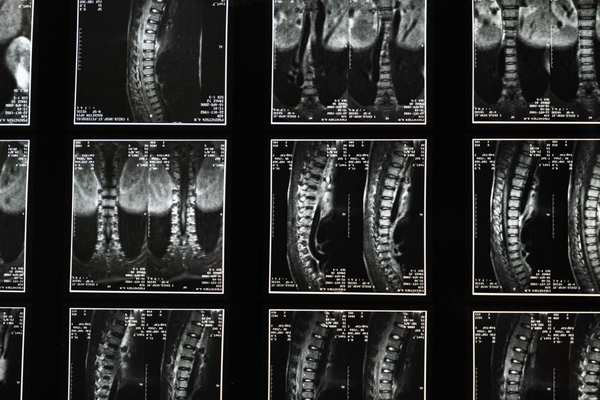 spinal cord injury compensation claim